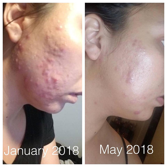 Super Acne Fighter / Organic Acne Treatment / Acne, 120 ml