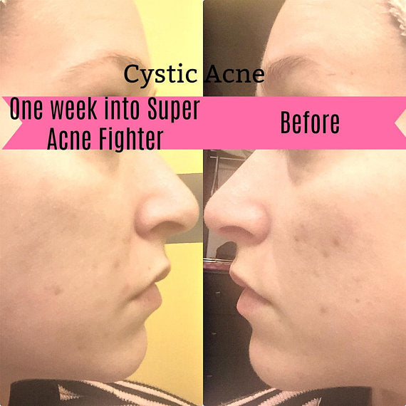 Super Acne Fighter / Organic Acne Treatment / Acne, 120 ml
